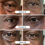 Microneedle Patches | New Generation
