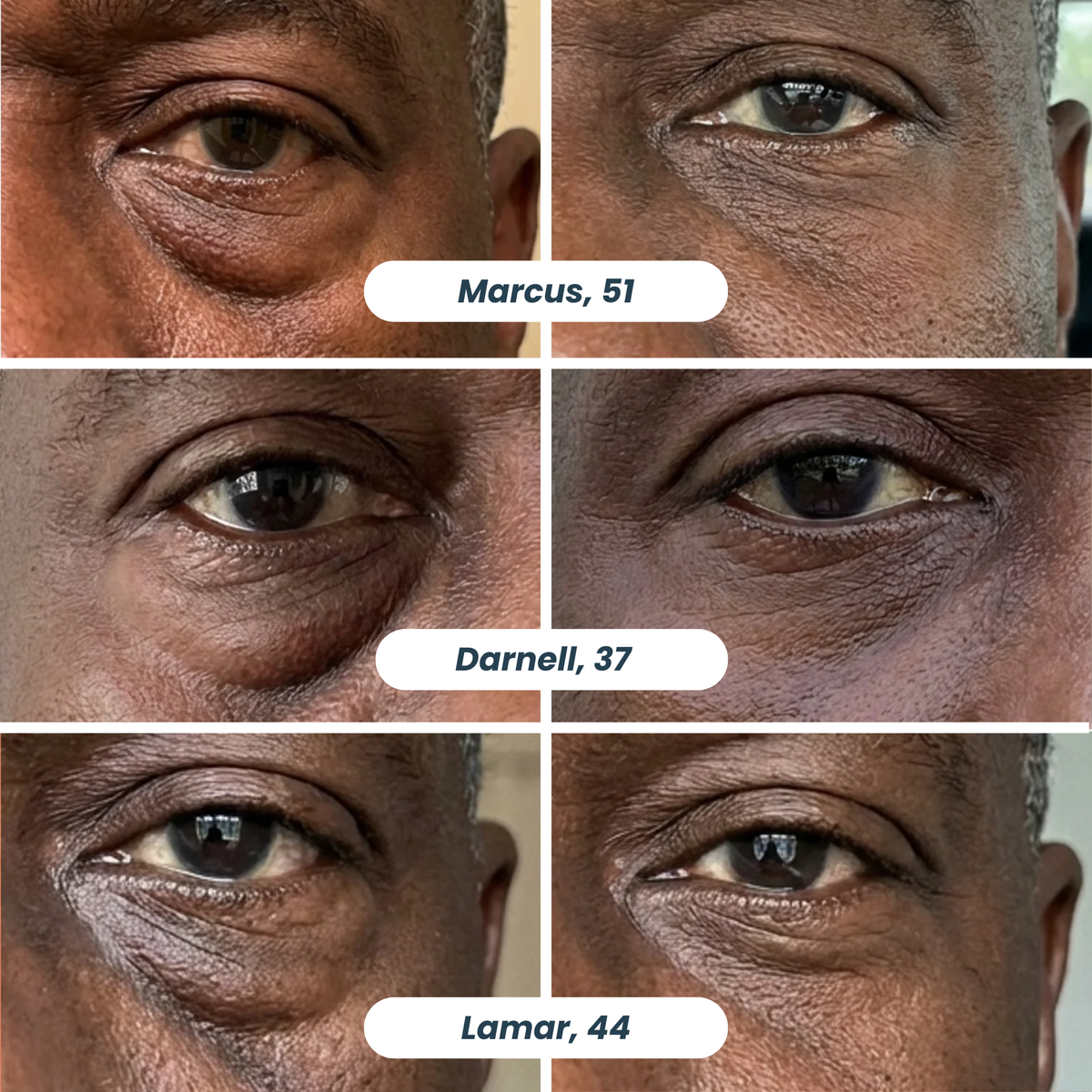 Microneedle Patches | New Generation