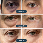 Microneedle Patches | New Generation