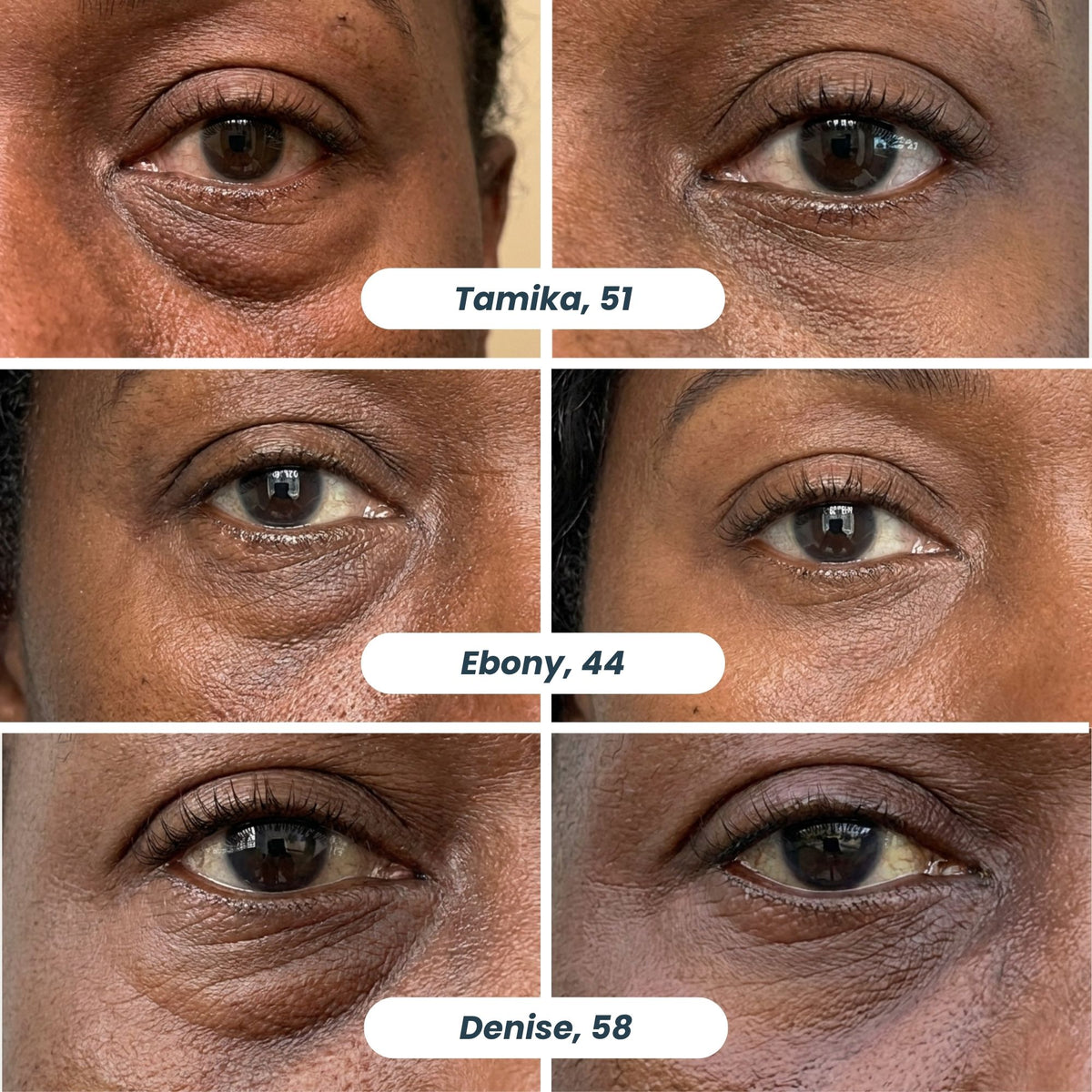 Microneedle Patches | New Generation